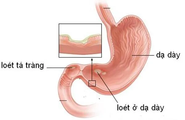 Top 10 Ảnh hưởng của stress đối với sức khỏe phụ nữ và cách khắc phục