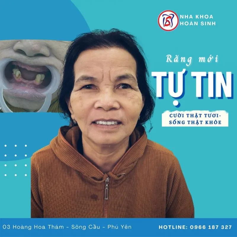 Top 8 Địa chỉ bọc răng sứ uy tín nhất tỉnh Phú Yên