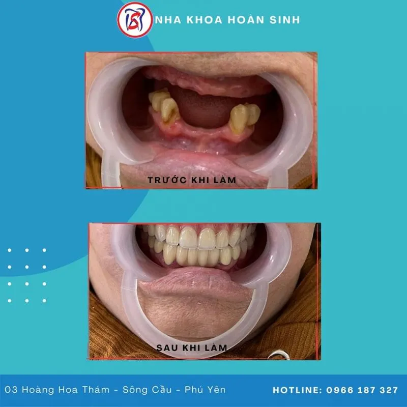 Top 8 Địa chỉ bọc răng sứ uy tín nhất tỉnh Phú Yên