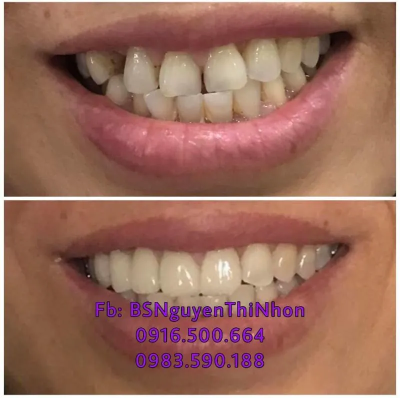 Top 8 Địa chỉ bọc răng sứ uy tín nhất tỉnh Phú Yên