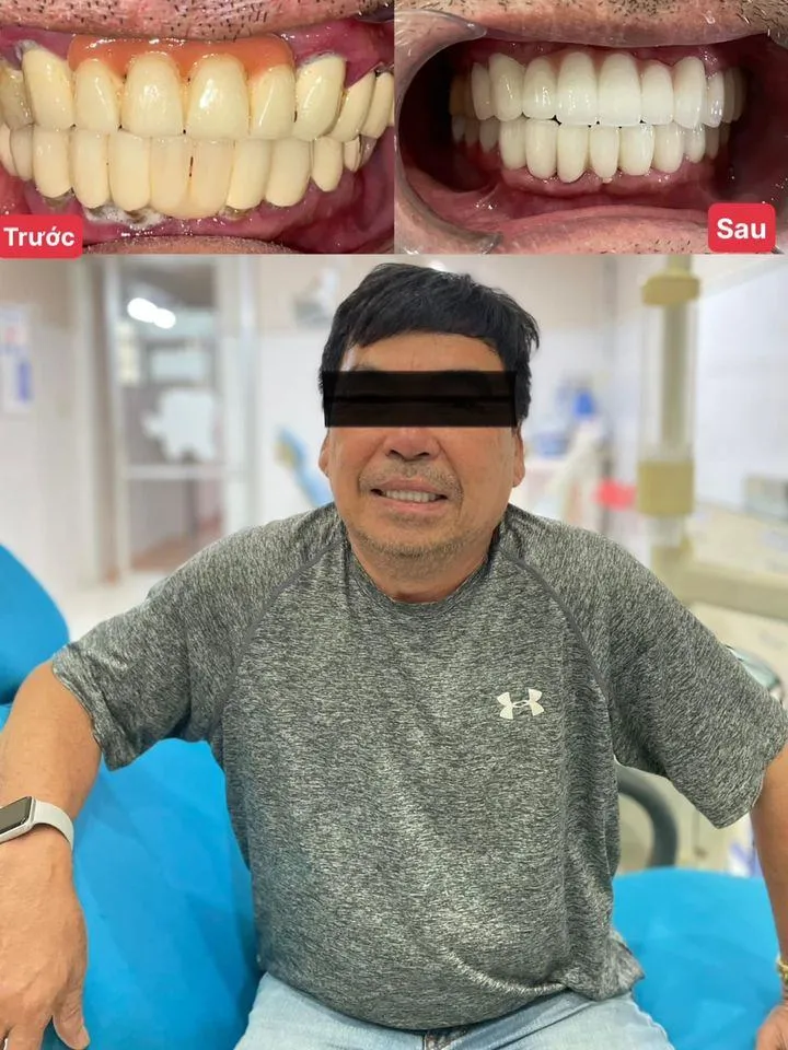 Top 8 Địa chỉ bọc răng sứ uy tín nhất tỉnh Phú Yên